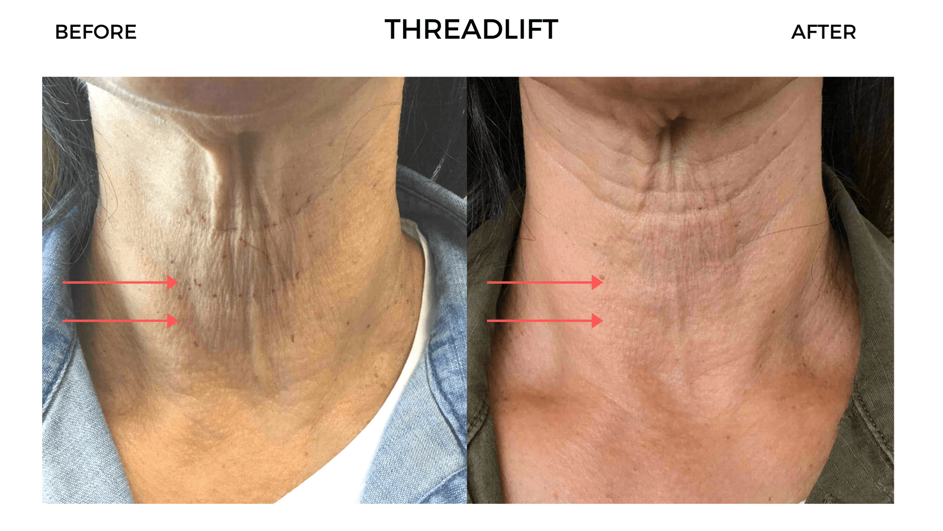 Threadlift Before and After
